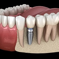 Animation of implant supported tooth
