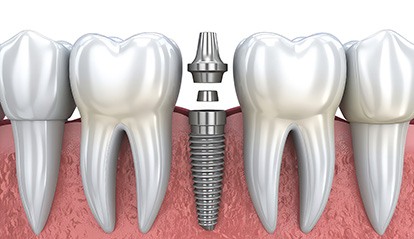 Dental Implants are the closest prosthetics to your natural teeth