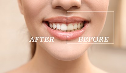 Patient's teeth before and after teeth whitening